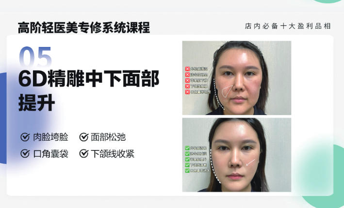 轻医美6D 中下面部精雕提升课程
